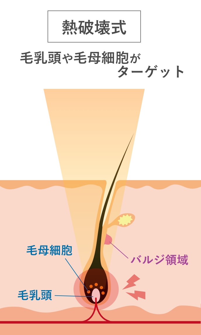 熱破壊式レーザー照射イメージ